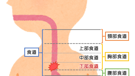 食道が破裂する？特発性食道破裂！