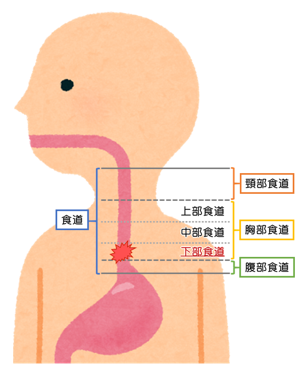 食道が破裂する?特発性食道破裂! 痛くない経鼻内視鏡検査をお探しの方は新横浜のららぽーと横浜クリニックへ 食道が破裂する?特発性食道破裂! 痛くない経鼻内視鏡検査をお探しの方は新横浜のららぽーと横浜クリニックへ