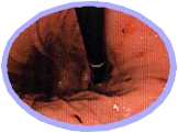 慢性胃炎患者の胃（内視鏡像）