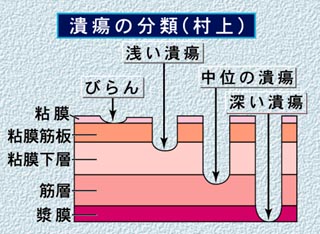 「潰瘍」と「びらん」の違いとは？