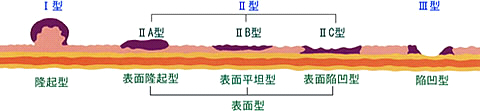 肉眼型による胃がんの分類