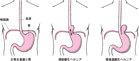 食道裂孔ヘルニア