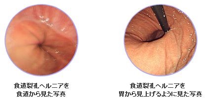 食道裂孔ヘルニア