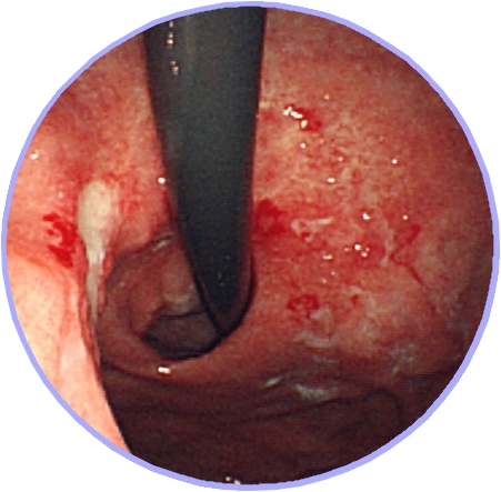 要注意！　胃潰瘍と似ている胃がん