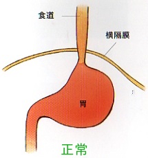 逆流性食道炎の原因は複合的