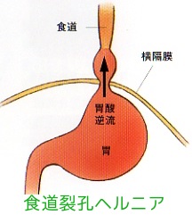 逆流性食道炎の原因は複合的