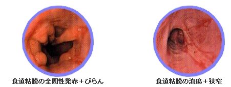 逆流性食道炎の診断は内視鏡検査で