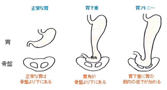 胃アトニーとは