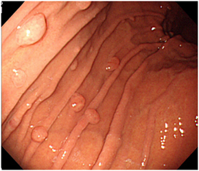 胃底腺ポリープってどんなもの？