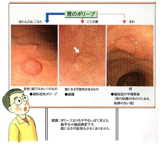 がんと胃ポリープの違い