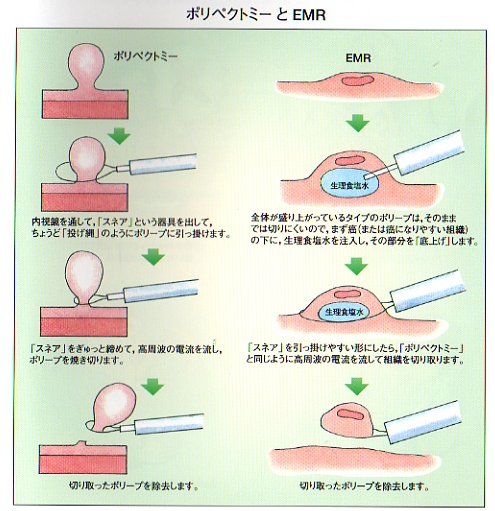 胃ポリープの治療は内視鏡切除