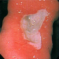 ピロリ菌感染例の胃潰瘍