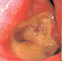 ピロリ菌感染例の十二指腸潰瘍