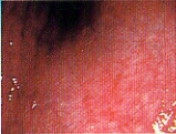 ピロリ菌感染例の萎縮性胃炎