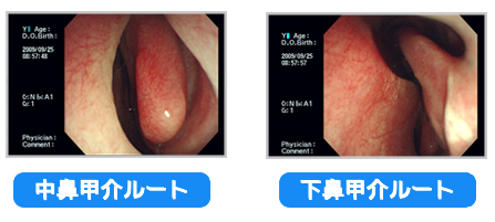 中鼻甲介ルートと上鼻甲介ルート